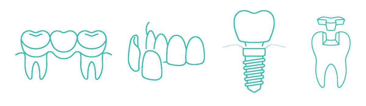 Grafische Abbildung von Zahnersatz-Möglichkeiten